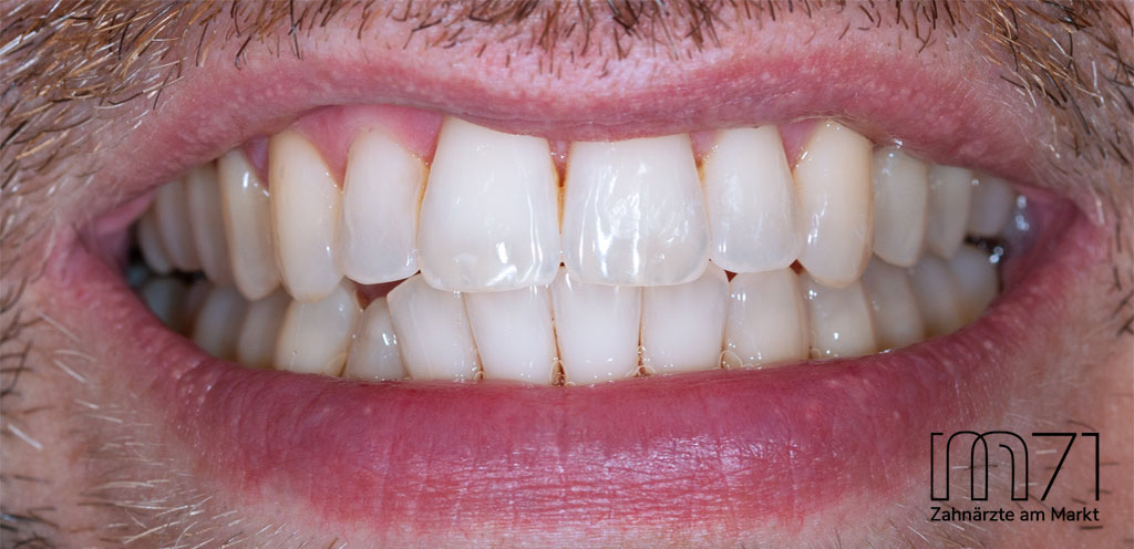 Invisalign - nachher