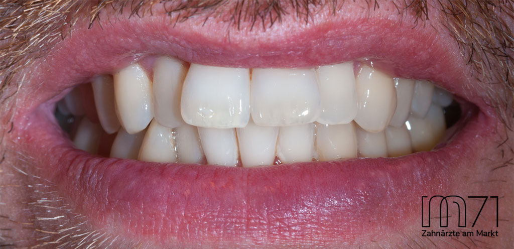 Invisalign - Vorher